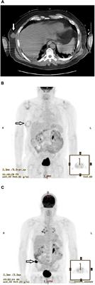 Case Report: Malignant Melanoma Associated With COVID-19: A Coincidence or a Clue?